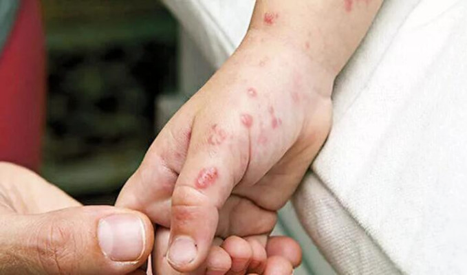 Ankara’da maymun çiçeği iddiası!