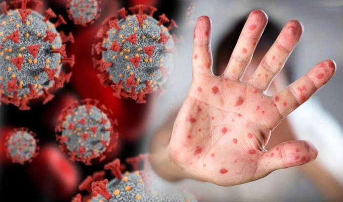 DSÖ’den kritik açıklama: Maymun çiçeği ve Kovid-19 bulaşma farkı…