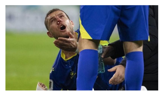 Edin Dzeko’nun, Romanya maçında burnu kırıldı